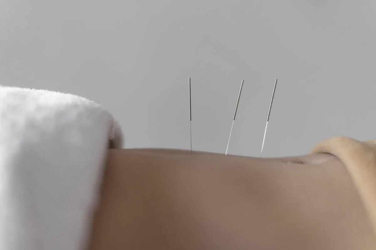 Close-up of a practitioner's hand steadying a fine filiform needle during treatment
